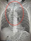 Tức ngực hậu Covid-19 - Bệnh nhân 55 tuổi bàng hoàng phát hiện xẹp phổi nghiêm trọng
